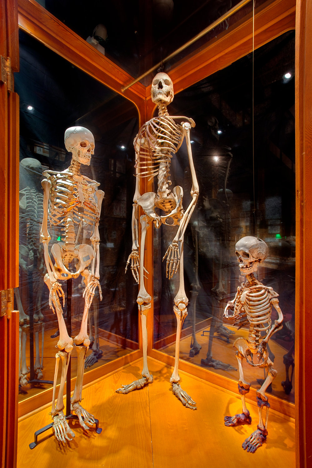 Skeletons of the American Giant and Mary Ashberry, drawf, with average